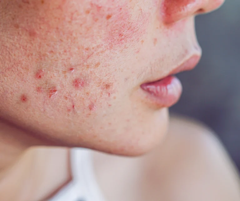 Treating Dermatological Skin Conditions from the Inside - Out